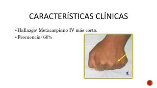 Hallazgo: Metacarpiano IV más corto.
Frecuencia: 60%
 