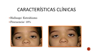 Hallazgo: Estrabismo
Frecuencia: 18%
 