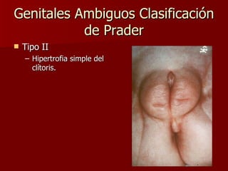 Genitales Ambiguos Clasificación de Prader Tipo II Hipertrofia simple del clítoris. 