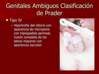 Genitales Ambiguos Clasificación de Prader Tipo IV Hipertrofia del clítoris con apariencia de micropene con hipospadias perineal, fusión completa de los labios mayores con apariencia escrotal.  