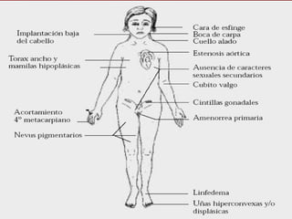 Hallazgos Clínicos en el Síndrome de Turner 