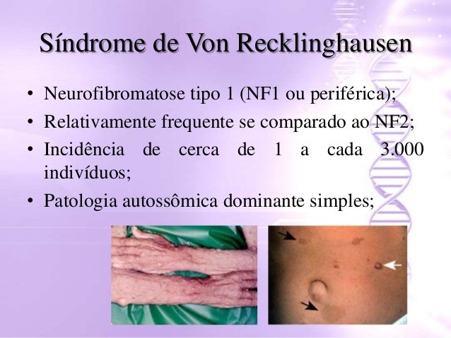 Neurofibromatosis de recklinghausen pdf to jpg