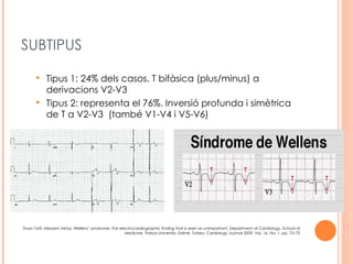 SUBTIPUS

           Tipus 1: 24% dels casos. T bifàsica (plus/minus) a
            derivacions V2-V3
           Tipus 2: representa el 76%. Inversió profunda i simètrica
            de T a V2-V3 (també V1-V4 i V5-V6)




Ersan Tatli, Meryem Aktoz, Wellens’ syndrome: The electrocardiographic finding that is seen as unimportant, Department of Cardiology, School of
                                                     Medicine, Trakya University, Edirne, Turkey; Cardiology Journal 2009, Vol. 16, No. 1, pp. 73–75
 