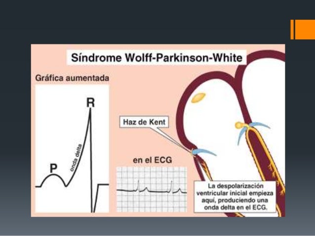 Wolff Parkinson White Si Muore