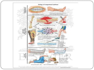 Desencadeada por atividades físicas.