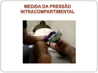 Os clássicos seis PsPain.Pressure.Pulso.Paraesthesia.Paresia.Pink color.Não devem ser utilizados para fazer diagnóstico precoce da síndrome do compartimento, pois só aparecem tardiamente, quando as alterações são irreversíveis e as sequelas inevitáveis.