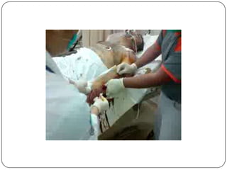 Síndrome aguda do compartimentoFasciotomiadescompressiva de urgência Permite a expansão dos tecidos, a normalização da pressão e, como consequência , a reperfusão