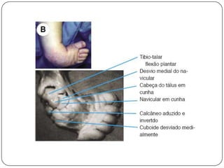 Aparelhos gessados inadequados