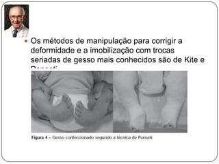 DiagnósticoO diagnóstico do pé torto congênito é evidente, observando-se as deformidade referidas: Pé equino varo, cavo,aduto e supino.O grau de deformidade e flexibilidade é variável.Além das deformidades características do PTC , observam-se uma atrofia da perna e um tamanho menor do pé.