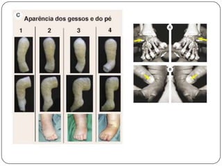 ClassificaçãoClassifica-se o pé torto em:PosturalIdiopático ou verdadeiroTeratológico