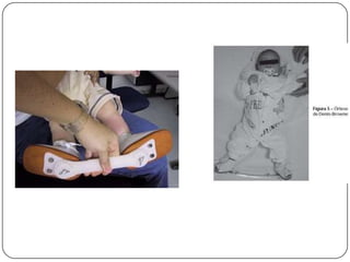 PTC postural é flexível e corrigido com manipulação ou necessita  somente de algumas trocas de gesso para obter a correção das deformidades.PTC Idiopático ou verdadeiro, a deformidade é mais acentuada e pouco flexível.PTC teratológico caracteriza-se pela rigidez, associação a síndromes, dificuldade de correção e altas taxas de recidiva