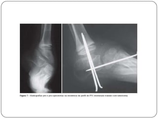 >Ângulo de Kite  maior o varismo< Ângulo de Kite  maior o valgismo