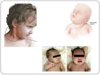 As complicações descritas são :Recidiva da deformidade. Pé “em mata-borrão”.HipercorreçãoRigidezFraqueza muscularJoanete dorsal  