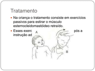 Quadro clínicoCabeça inclinada em direção ao músculo contraídoQueixo voltado para o ombro contralateralSe manifesta no parto ou pode se desenvolver no início do período neonatal por volta da segunda ou terceira semanas de vida.A inclinação lateral da cabeça para o lado oposto e a rotação do queixo para o lado envolvido são situações restritas.