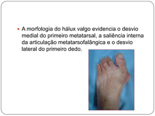 DiagnósticoAo elaborar a história de uma criança com torcicolo elaborar as seguintes perguntas específicas:1) A ordem do nascimento – o torcicolo é mais comum no primeiro filho2)A apresentação do parto- ele é mais frequente nos partos fórceps e com apresentação de nádegas3) Houve quaisquer lesões ou evidência de traumatismo?    A clavícula foi fraturada por compressão dos ombros durante o parto difícil?     Quando isso ocorre a tensão sobre o músculo esternocleidomastóideo inclina a cabeça em direção ao lado afetado  e gira o queixo para o lado oposto.    No RN é comum diagnosticar incorretamente uma fratura de clavícula com torcicolo muscular congênito.