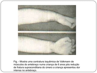 Resulta na perda completa da musculatura afetada, sendo esta substituída por tecido cicatricial,que, retraído, produz deformidade distais.