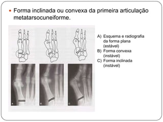 TratamentoNa criança o tratamento consiste em exercícios passivos para estirar o músculo esternocleidomastóideo retraído.Esses exercícios são feitos pelos pais após a instrução adequada.