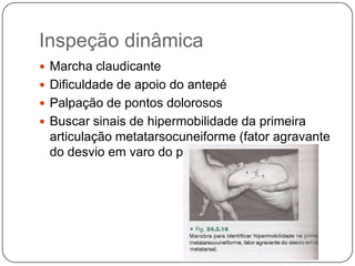 EtiologiaVários fatores que produzem ou predispõem ao aparecimento do háluxvalgo são descritos.O uso de calçados inadequados tem sido considerado a principal causaA posição em varo do 1 metatarsiano, que é normal até 12 graus seria outro fator etiológico.