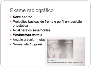Fatores intrínsecosPé plano valgoHipermobilidade da primeira articulação metatarsocuneiforme