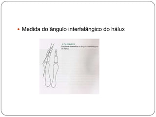 Forma inclinada ou convexa da primeira articulação metatarsocuneiforme.Esquema e radiografia da forma plana (estável)Forma convexa (instável)Forma inclinada (instável)