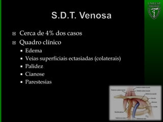  Cerca de 4% dos casos
 Quadro clínico
 Edema
 Veias superficiais ectasiadas (colaterais)
 Palidez
 Cianose
 Parestesias
 