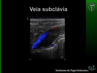 Síndrome de Paget-Schroetter
 