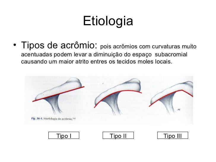 Síndrome do impacto Síndrome do impacto