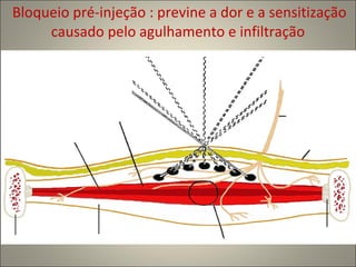 Bloqueio pré-injeção : previne a dor e a sensitização causado pelo agulhamento e infiltração 