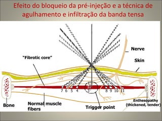 Efeito do bloqueio da pré-injeção e a técnica de agulhamento e infiltração da banda tensa “ Fibrotic core” Nerve Skin Bone Normal muscle fibers Trigger point Enthesopathy (thickened, tender) 