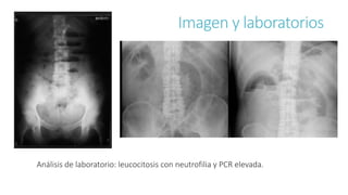 Imagen y laboratorios
Análisis de laboratorio: leucocitosis con neutrofilia y PCR elevada.
 