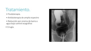 Tratamiento.
• Fluidoterapia.
• Antibioterapia de amplio espectro
• Reducción por enema de bario o
agua bajo control ecográfico
• Cirugía.
 