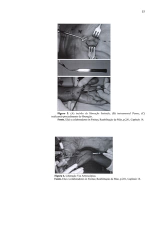 15
Figura 5. (A) incisão da liberação limitada; (B) instrumental Penne; (C)
realizando procedimento de liberação.
Fonte. Elui e colaboradores in Freitas; Reabilitação de Mão, p.281, Capitulo 18.
Figura 6. Liberação Via Artroscópica.
Fonte. Elui e colaboradores in Freitas; Reabilitação de Mão, p.281, Capitulo 18.
 