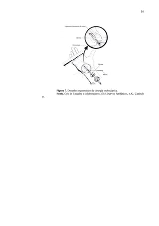 16
Figura 7. Desenho esquemático de cirurgia endoscópica.
Fonte. Griz in Tatagiba e colaboradores 2003; Nervos Periféricos, p.82, Capitulo
14.
 