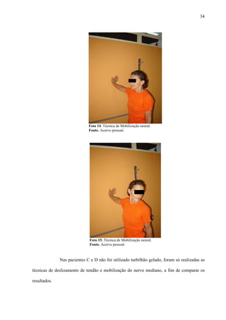 34
Foto 14. Técnica de Mobilização neural.
Fonte. Acervo pessoal.
Foto 15. Técnica de Mobilização neural.
Fonte. Acervo pessoal.
Nas pacientes C e D não foi utilizado turbilhão gelado, foram só realizadas as
técnicas de deslizamento de tendão e mobilização do nervo mediano, a fim de comparar os
resultados.
 