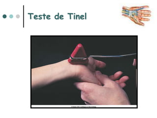 Teste de Tinel
 