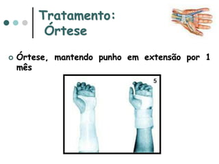 Tratamento:
Órtese
 Órtese, mantendo punho em extensão por 1
mês
 