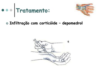 Tratamento:
 Infiltração com corticóide – depomedrol
 