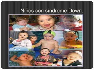 Niños con síndrome Down.
 
