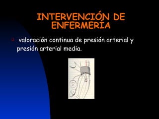 INTERVENCIÓN DE ENFERMERÍA valoración continua de presión arterial y presión arterial media. 