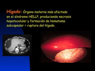 Hígado:   Órgano materno más afectado en el síndrome HELLP, produciendo necrosis hepatocelular y formación de hematoma subcapsular = ruptura del hígado. 