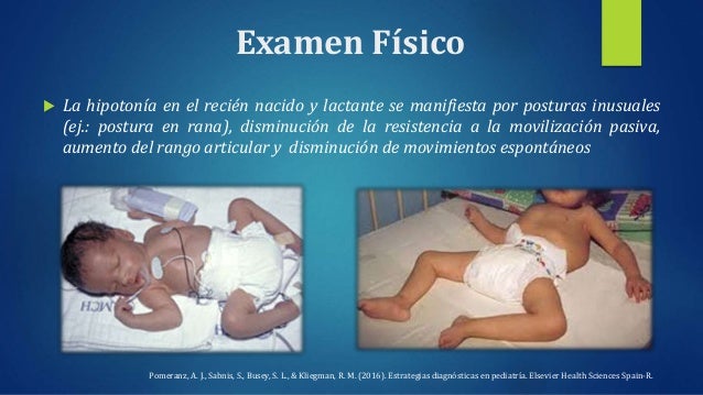 Síndrome hipotónico