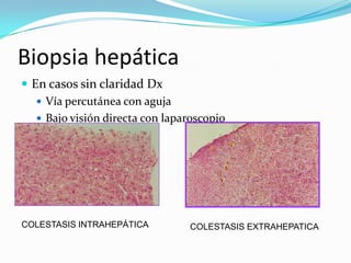 Biopsia hepática
 En casos sin claridad Dx
    Vía percutánea con aguja
    Bajo visión directa con laparoscopio




COLESTASIS INTRAHEPÁTICA         COLESTASIS EXTRAHEPATICA
 