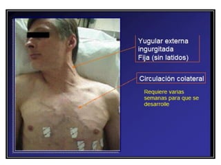 S ndrome Mediastinal PDF s-ndrome-mediastinal-pdf