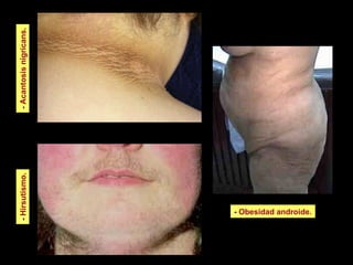 -  Obesidad androide. -  Acantosis nigricans. -  Hirsutismo. 