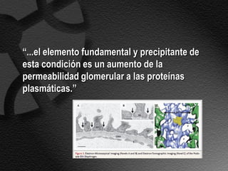 “...el elemento fundamental y precipitante de
esta condición es un aumento de la
permeabilidad glomerular a las proteínas
plasmáticas.”
 