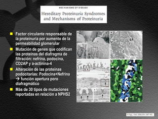  Factor circulante responsable de
  la proteinuria por aumento de la
  permeabilidad glomerular
 Mutación de genes que codifican
  las proteínas del diafragma de
  filtración: nefrina, podocina,
  CD2AP y a-actinina-4
 Alteración de las proteínas
  podocitarias: Podocina+Nefrina
   función apertura poro
  diafragmático
 Más de 30 tipos de mutaciones
  reportadas en relación a NPHS2
 