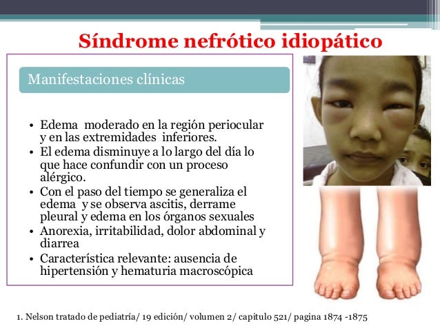 Síndrome nefrótico