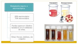 Hematuria macro o
microscópica.
30% macroscópica
70% microscópica
Pueden aparecer cilindros
hemáticos en el sedimento
de orina.
Orina: Oscura, indolora, sin
coágulos
 
