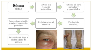 Edema
(80%)
Debido a la
retención
hidrosalina.
Habitual en cara,
párpados y
extremidades
Predominio
matutino.
Es infrecuente el
anasarca.
Genera ingurgitación
yugular y congestión
pulmonar
En ocasiones llega a
edema agudo de
pulmón
 