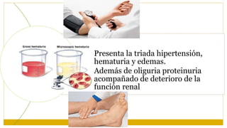 • Presenta la triada hipertensión,
hematuria y edemas.
• Además de oliguria proteinuria
acompañado de deterioro de la
función renal
 